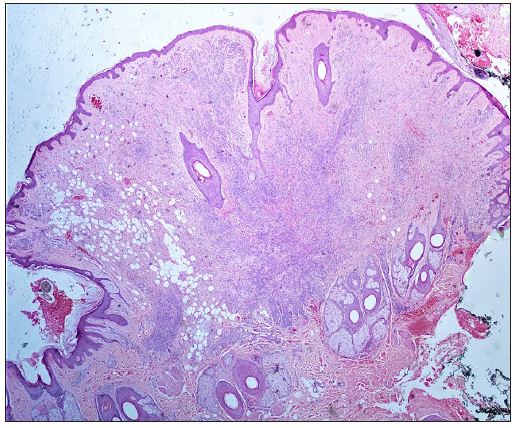 Histology showing multiple nests of naevoid melanocytes extending from the papillary to the deep reticular dermis and along the hair follicles (Haematoxylin and eosin, 40×).